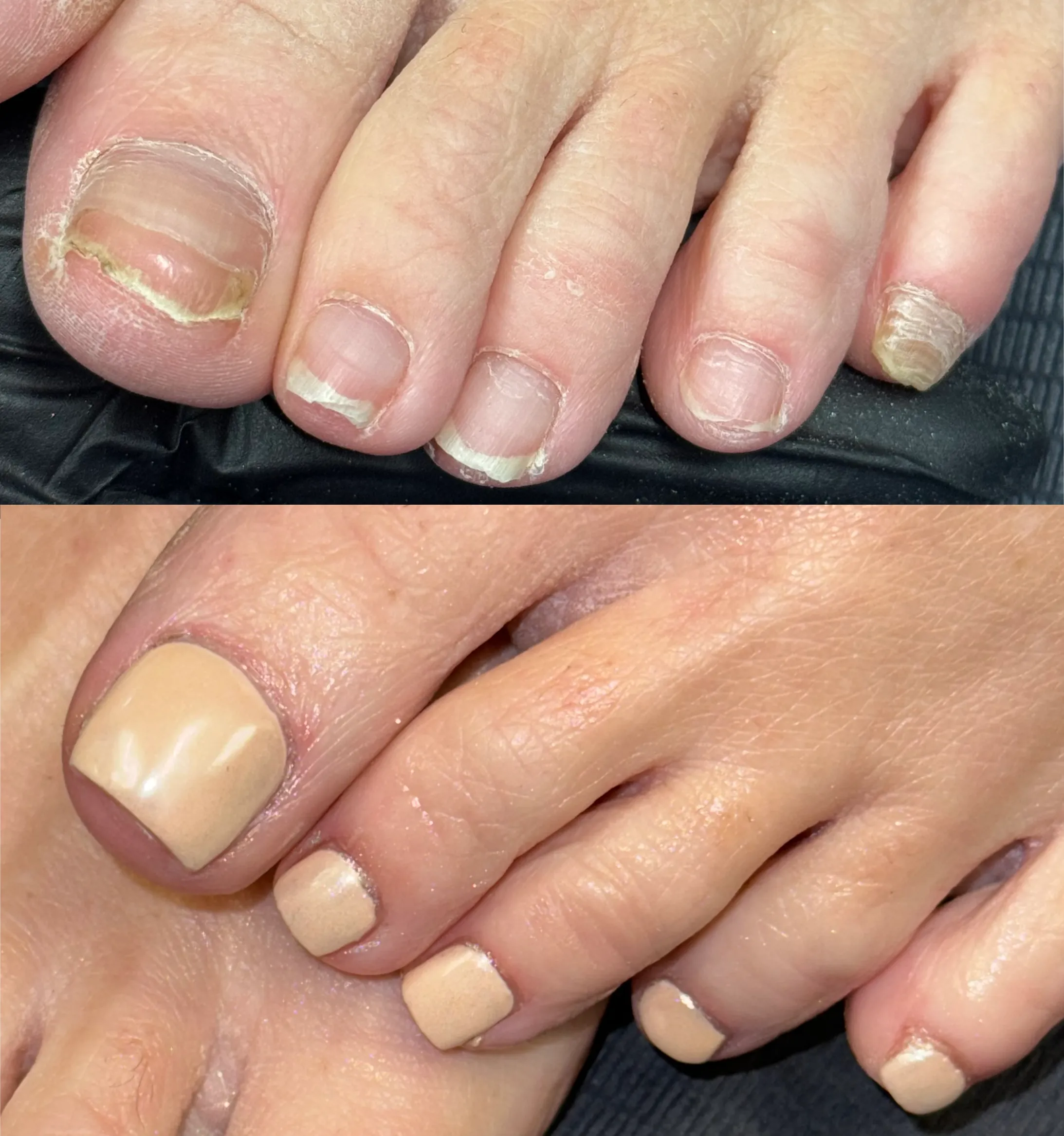 Photo with client before and after big toe reconstruction by Jodie Leslie.