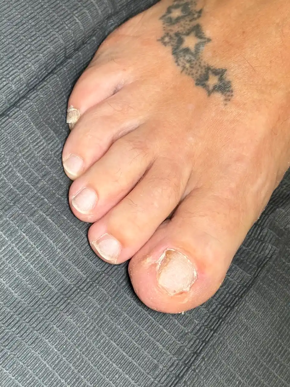 Nails at start of reconstruction journey